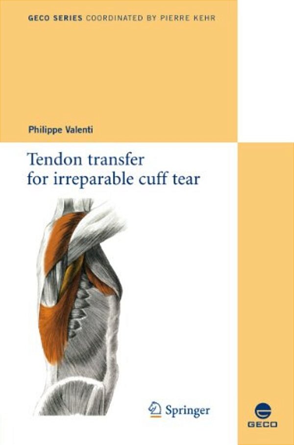 Tendon Transfer For Irreparable Cuff Tear-..