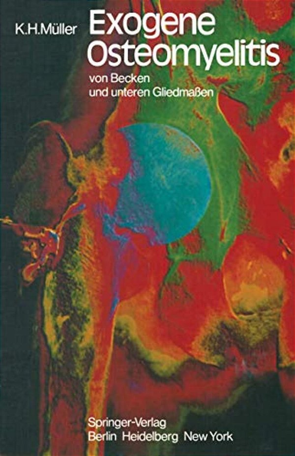 Exogene Osteomyelitis Von Becken Und Unteren Gliedmaßen: Besonderheiten Pathogenese Klinik Therapie Ergebnisse-..
