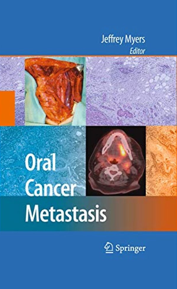 Oral Cancer Metastasis-..