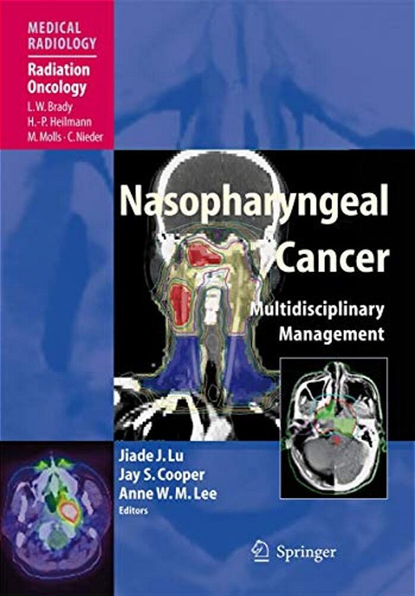 Nasopharyngeal Cancer: Multidisciplinary Management-..