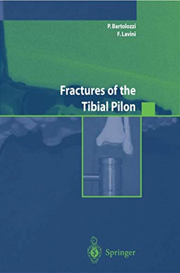Fractures Of The Tibial Pilon-..