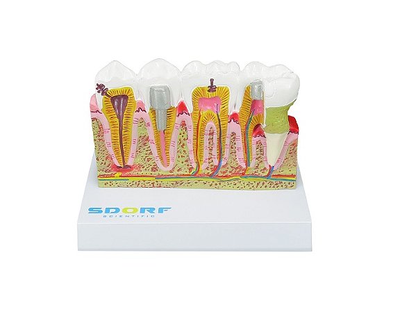 MODELO DE PATOLOGIAS DENTÁRIA