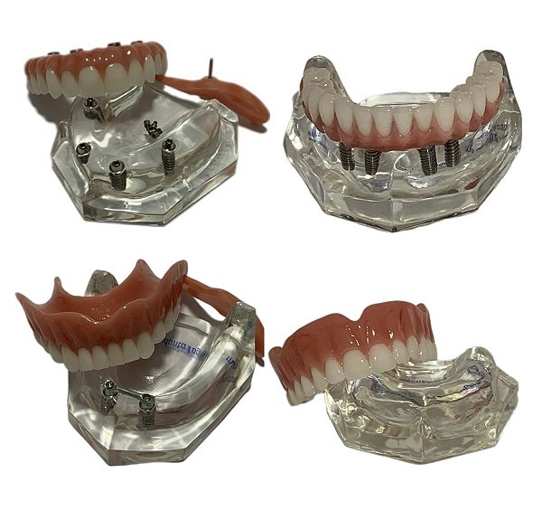 Manequins Protocolo Sup. 4 Impl.(All-On-Four). Protocolo Inf.  4 Impl. Overdenture Barra Clip e Prótese Total Sup. Kit c/ 4