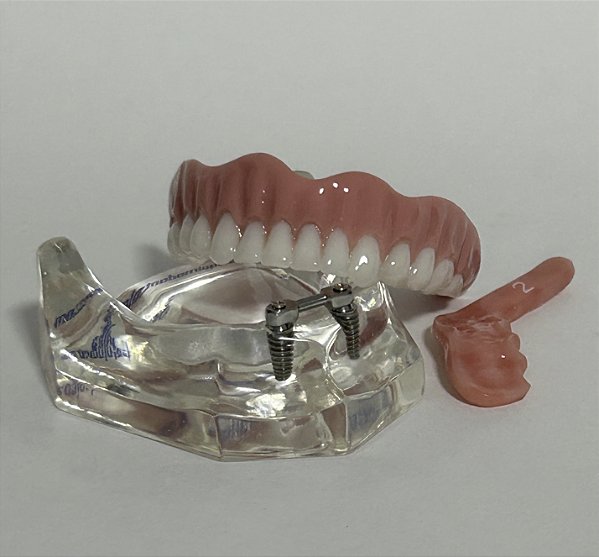 Manequim Modelo Odontológico Overdenture Barra Clipe Inferior 2 Implantes