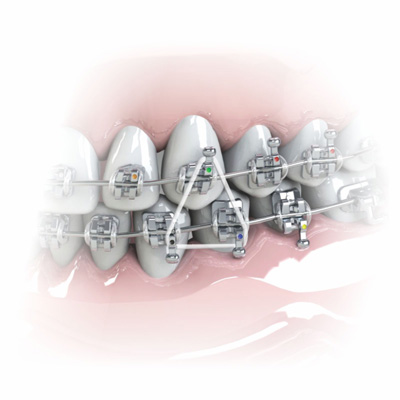 Elástico Intraoral "Silicone" Médio 5/16"