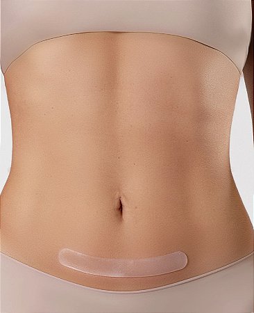 Kit C/4 Fitas em Gel Silicone Para Cicatriz e Queloide 15 X 2cm - Siliskin