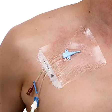 CURATIVO FILME TRANSPARENTE ESTERIL 10 X 12 SKINUPPER