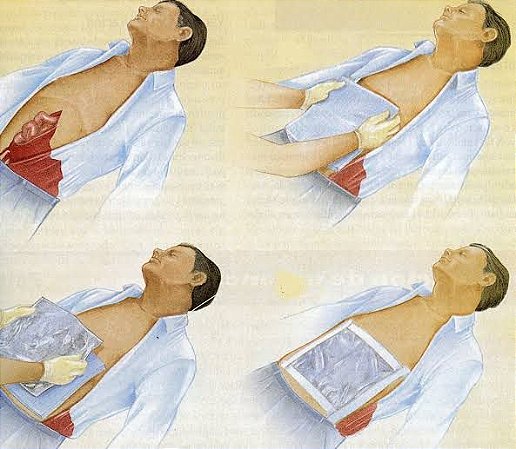 Protetor De Queimaduras E Evisceração 90x120cm - estéril - APH