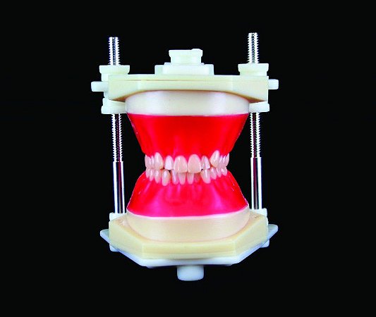 TYPODONT CLASSE I - APINHAMENTO SEVERO ANTERIOR ATRESIA MANDIBULA MAXILA TÉCNICA AUTO LIGADO