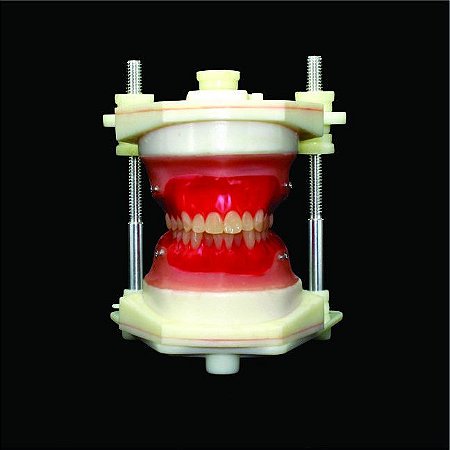 TYPODONT CLASSE I - APINHAMENTO MODERADO SUPERIOR INFERIOR TÉCNICA ANCORAGEM MINI IMPLANTE