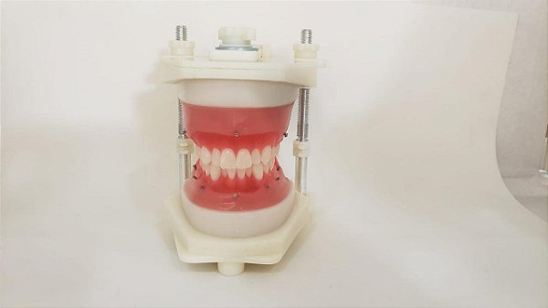 Typodont - Classe I com anteriores apinhados com mini implantes sem exodontia