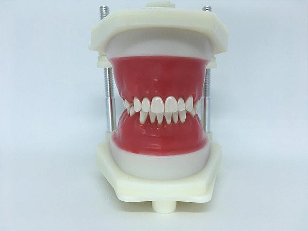 TYPODONT CLASSE I - Classe l - Apinhamento Severo Superior e Inferior, Extrações 14 ,24,34,44, espaço extrações 3mm - Cor do dente 60