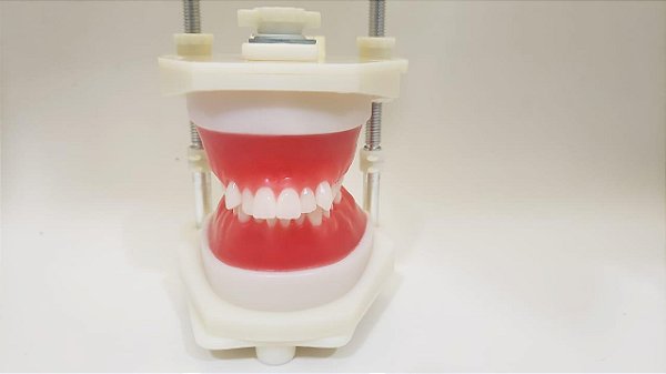 Typodont - Classe II divisão 1, com apinhamento superior inferior com todos os dentes, sem mini implantes