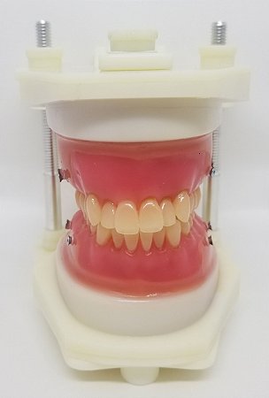 Typodont Classe II C/ Placa de Ancoragem Mini implante