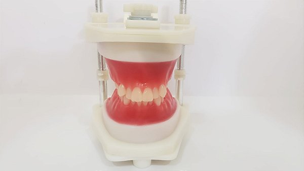 Typodont - Classe II com apinhamento severo nos superiores, suave nos inferiores sem mini implantes