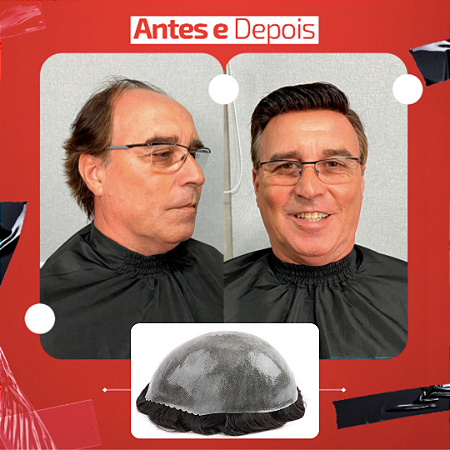 JAC 08 - 0,08mm PROTESE CAPILAR DE MICROPELE SEM KIT MANUTENÇÃO
