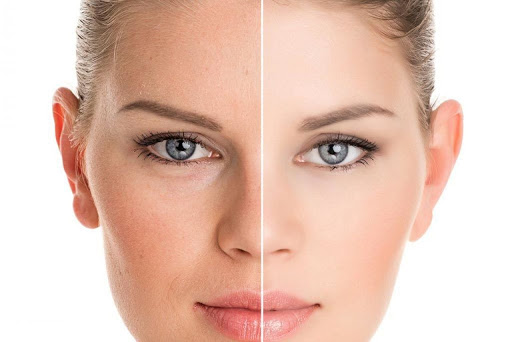 PEELING PARA ESTRIAS COM ACIDO RETINOICO
