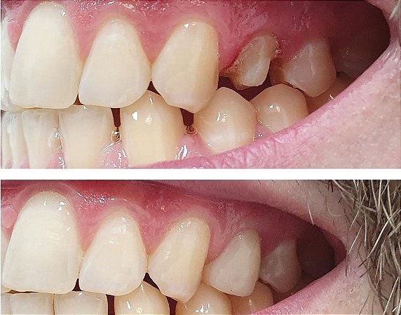 PRÓTESE DENTÁRIA
