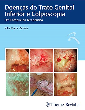 Livro Doenças do Trato Genital Inferior e Colposcopia