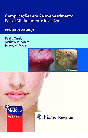 Livro Complicacoes em Rejuvenescimento Facial Minimamente Invasivo: Prevencao e M - Carniol/avram/brauer