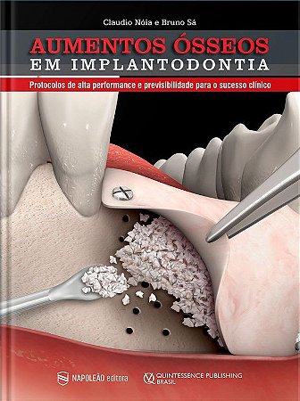 Livro Aumentos Ósseos em Implantodontia: Protocolos de Alta Perfomance e Previsivibilidade