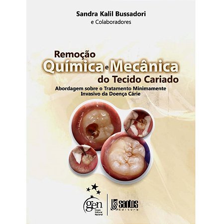 Livro Remoção Química: Mecânica da Carie  Bussadori