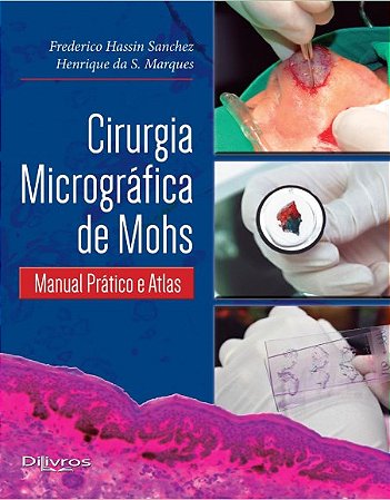 Cirurgia Micrográfica de Mohs