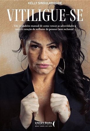 Vitiligue-se