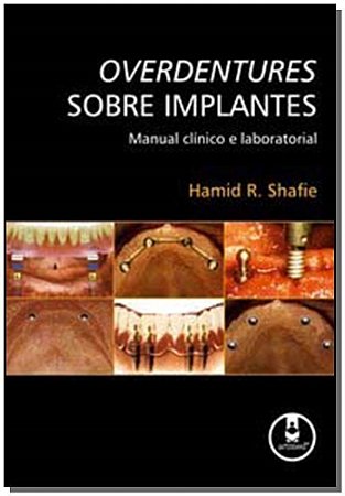 Overdentures Sobre Implantes:mn. Clin. e Lab.