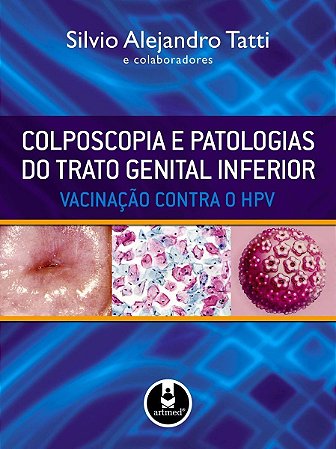 Colposcopia e Patologias Do Trato Genital Inferior