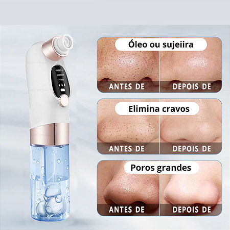 Removedor de Cravos a Vácuo – Pele Limpa e Saudável em Minutos