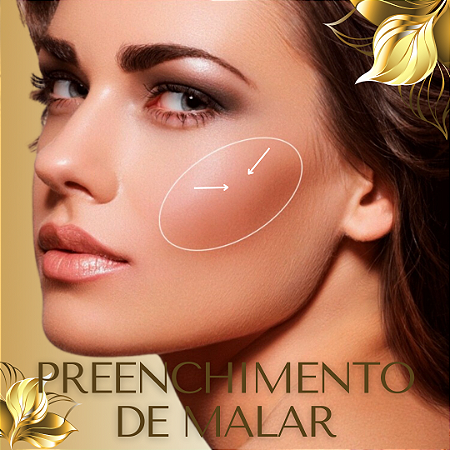 PREENCHIMENTO DE MALAR - 1 ml de ácido hialurônico