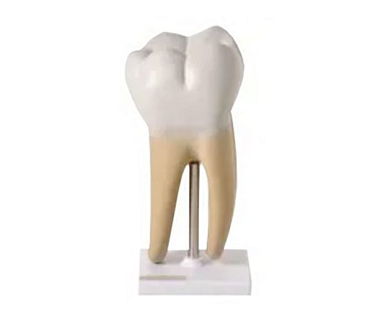 DENTE MOLAR AMPLIADO SAUDAVEL E COM CARIE