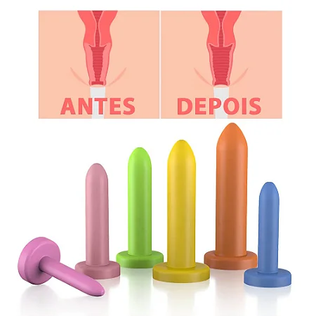 Kit de dilatadores vaginal graduados liso para tratamento de vaginismo - 6 unidades