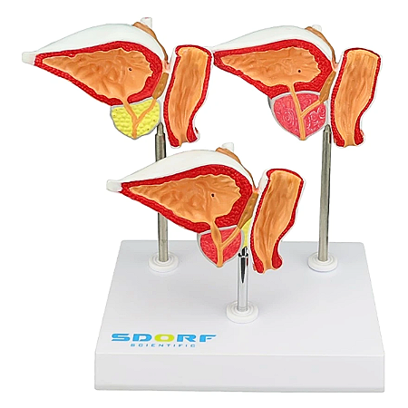 MODELO PATOLÓGICO DA PRÓSTATA EM 3 FASES - SD5211 - SDORF