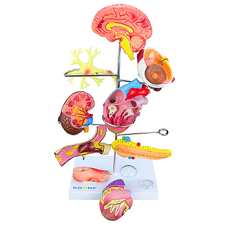 MODELO DE ÓRGÃOS AFETADOS PELA DIABETES EM 11 PARTES - SD5213 - SDORF