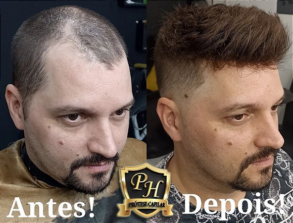 Prótese de Micropele de silicone