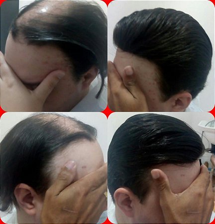 Prótese de Tela já colocada!