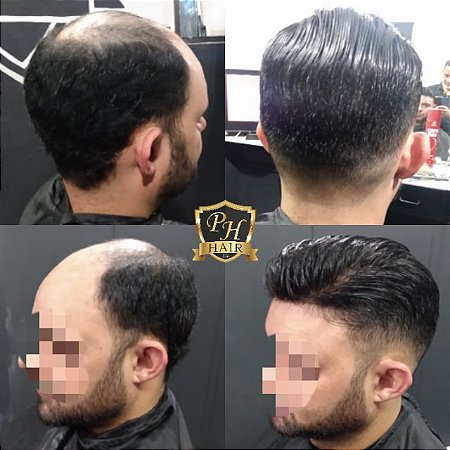 Prótese de Micro com 115 de densidade