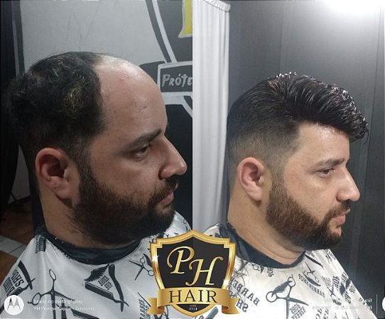 Prótese Híbrida (meio de Tela com as bordas de Silicone)