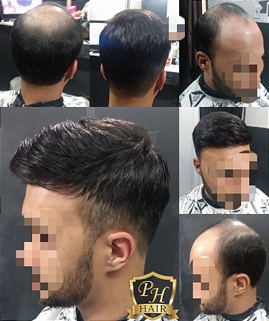 Prótese de Micro pele 1B