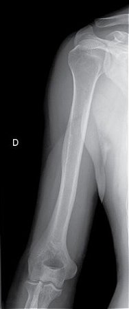 RX do Braço (unilateral)