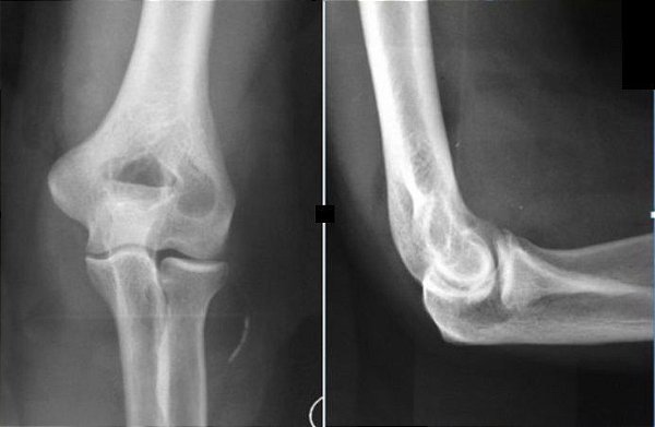 Rx do Cotovelo (unilateral)