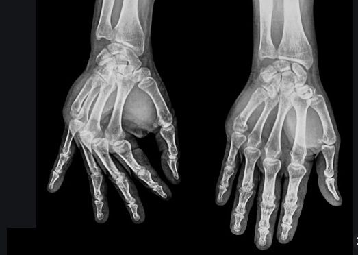 Rx da Mão (unilateral)