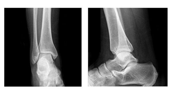 Rx do Tornozelo (unilateral)