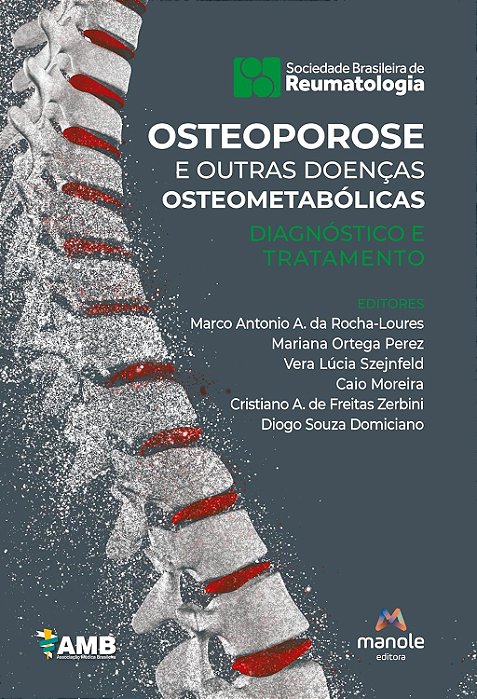 Osteoporose e Outras Doenças Osteometabólicas - 1ª Edição 2024