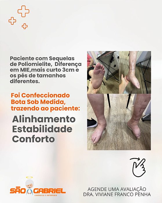 Calçado Sob Medida para Sequelas de Poliomielite