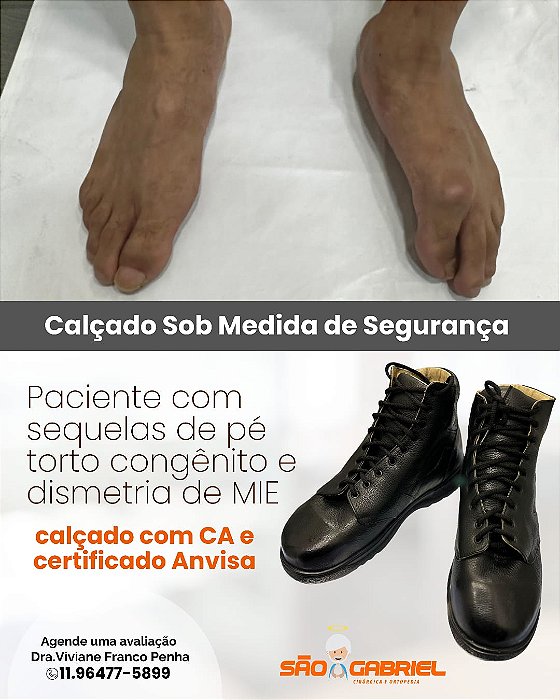 Calçado de Segurança Sob Molde paciente com pé torto congenito e dismetria