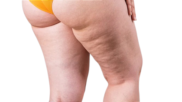 Lipedema (Tratamento Auxiliar)