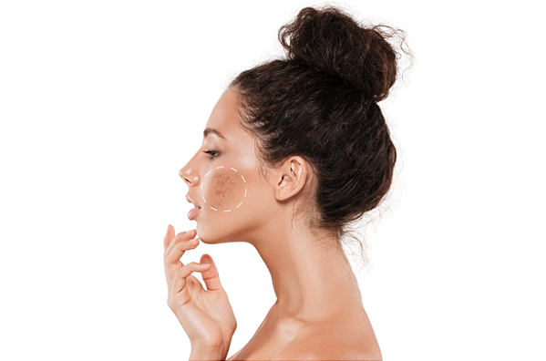 Tratamento Para Melasma Persistente